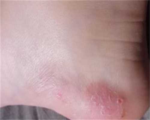 代生最专业机构移植冻胚第九天白板正常不