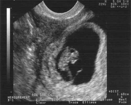 代孕中心排名,子宫内膜异位症做试管婴儿的成功率，移植方案的选择很重要